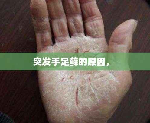 突发手足藓的原因,